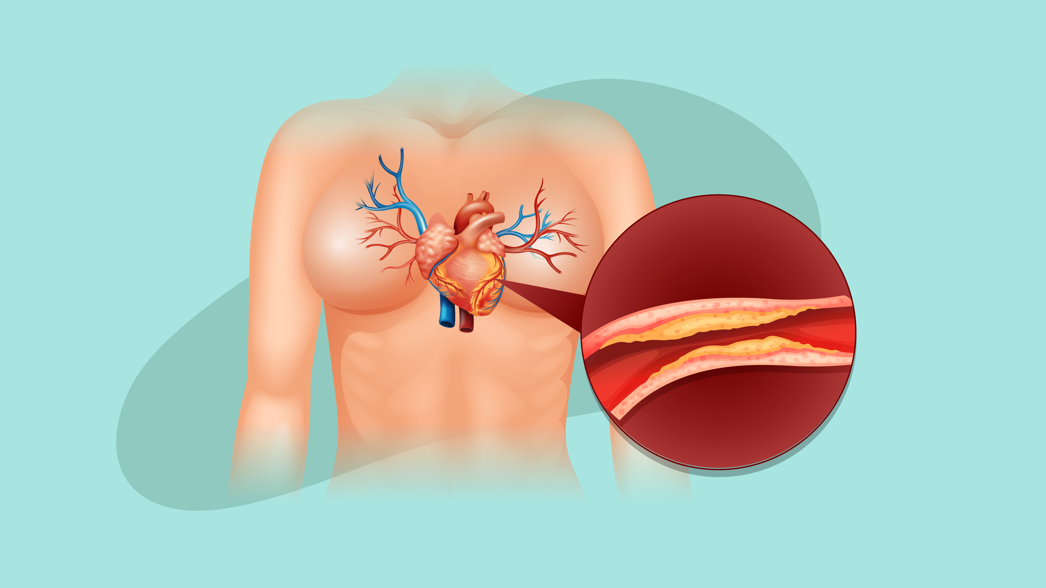 LDL cholesterol ( bad cholesterol) and HDL cholesterol (good cholesterol) are the Types of cholesterol.