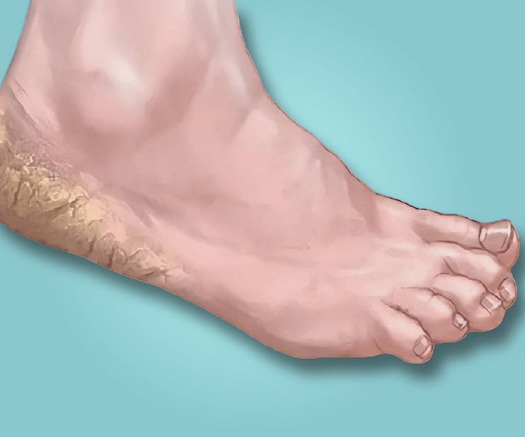 A seemingly unremarkable foot condition Cracked Heels can be shockingly upsetting and interfere with many people's daily lives.