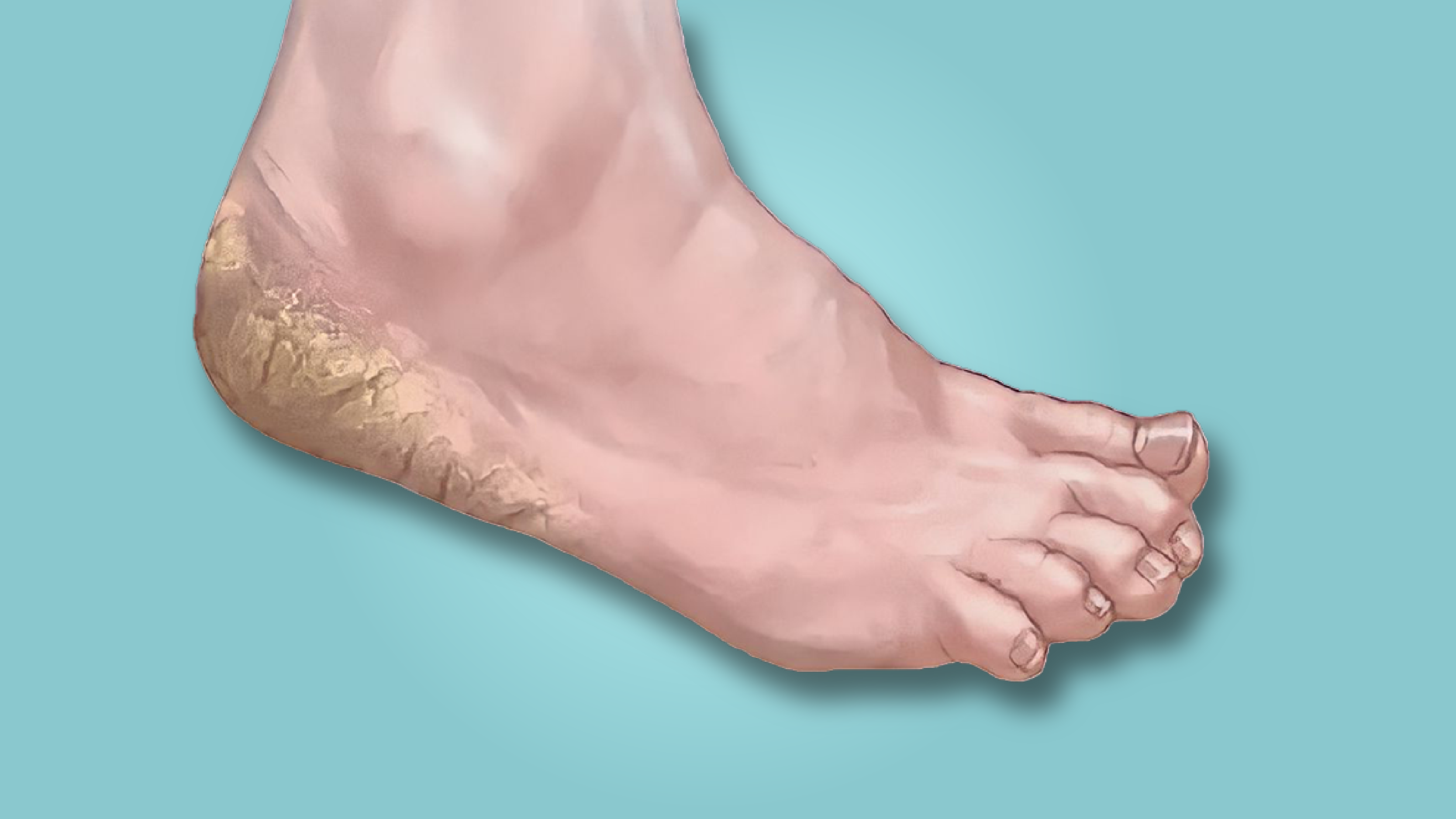A seemingly unremarkable foot condition Cracked Heels can be shockingly upsetting and interfere with many people's daily lives.