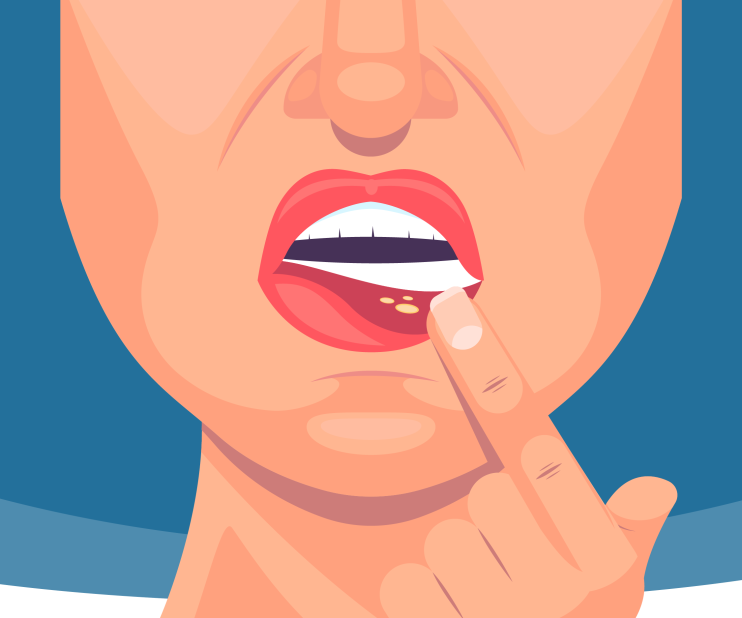 Mouth Ulcers can result from infections. Children and certain people with herpes simplex frequently develop mouth ulcers.