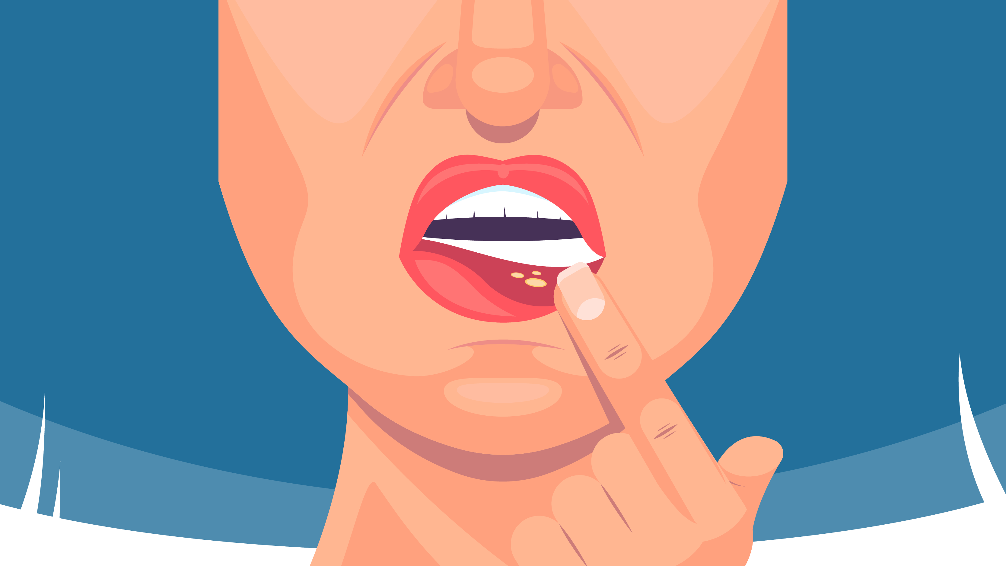 Mouth Ulcers can result from infections. Children and certain people with herpes simplex frequently develop mouth ulcers.