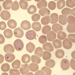 Babesiosis