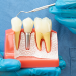Do Root Canal Cause Your Chronic Health Issue