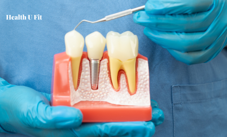 Do Root Canal Cause Your Chronic Health Issue