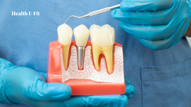 Do Root Canal Cause Your Chronic Health Issue