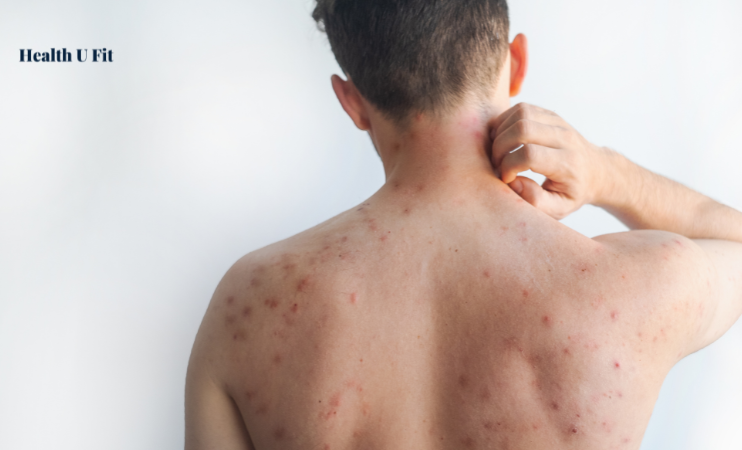 Eczema Causes, Symptoms, Types and Treatment Guide