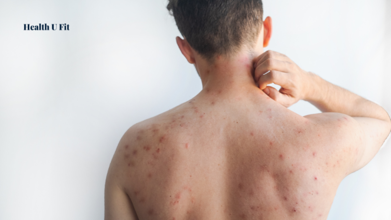 Eczema Causes, Symptoms, Types and Treatment Guide