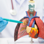 Pneumonia Causes, Symptoms, Treatment, and Prevention Guide