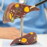 Hemochromatosis Causes, Symptoms, Treatment and Managing Iron Overload Naturally